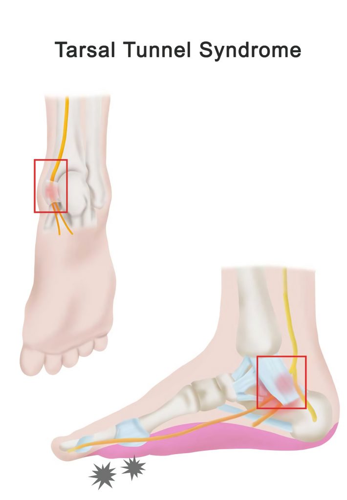 tarsal tunnel syndrome symptoms treatment sapnamed.com