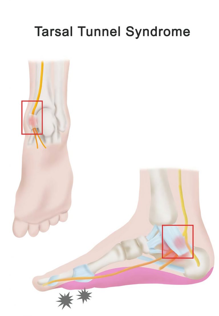 Tarsal Tunnel Syndrome Treatment in Fairfax, VA SAPNA Spine and