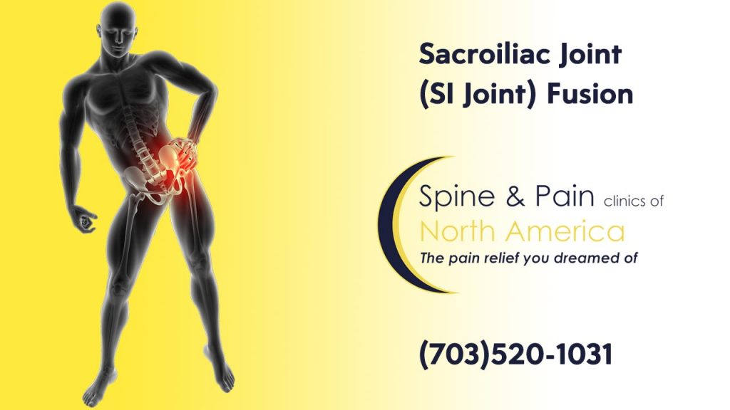 Sacroiliac Joint (SI Joint) Fusion at SAPNA: Spine and Pain Clinic of North America, and Dulles, VA