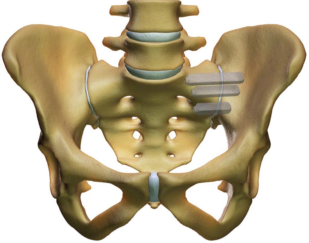titanium implants to stabilize the si joint
