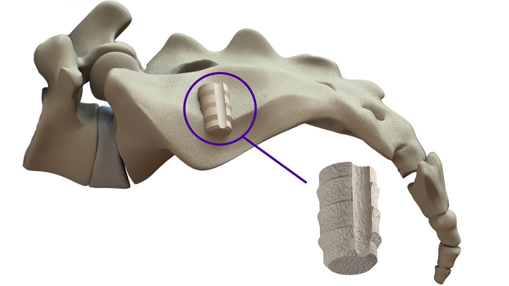 What Happens During The SiLO SI Fusion Procedure?