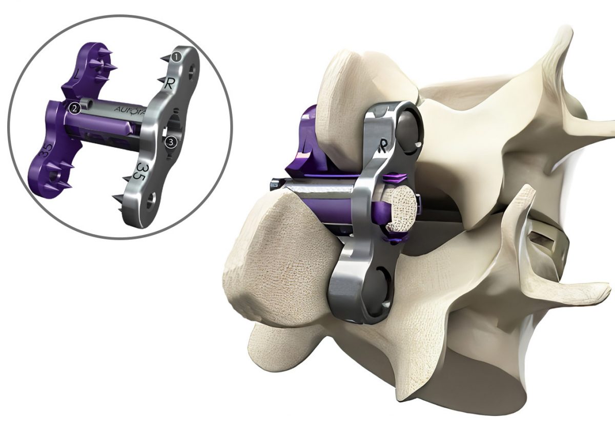 Zip procedure for spinal stabilization SAPNA Spine and Pain Clinic of