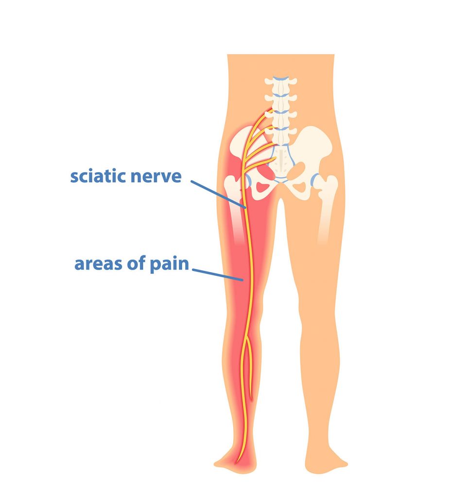 Sciatic Nerve Pain