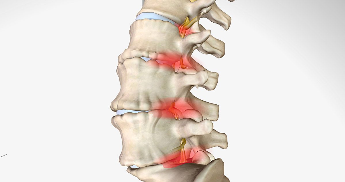 Spondylolisthesis