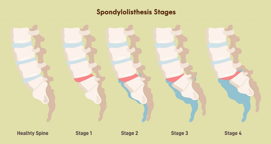 Spondylolisthesis Stages