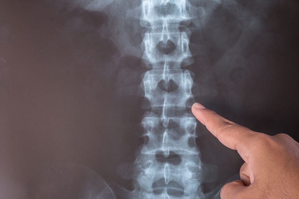 X-ray images can confirm the presence of scoliosis and the degree of spinal curvature.
